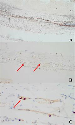 Immunoexpression of MMP-8 and MMP-9 in chronic subdural hematoma